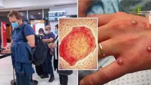 variola 1 - Situație îngrijorătoare! Alți doi bărbați din România- confirmați cu variola maimuței