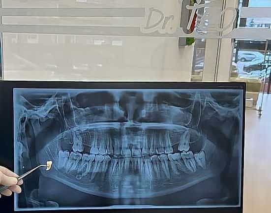extractia dentara extractie dr teo