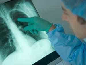 tbc - Femeie diagnosticată cu tuberculoză contagioasă- arestată și obligată să se trateze