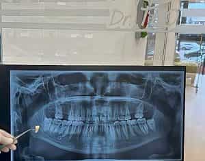 dr teo extractia dentara e1684064115227 - Situații în care este recomandată extracția unui dinte