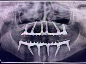 DENTAL STUDIO DR. CĂNĂNĂU: Dantură fixă în maximum 24 de ore! 2 poza implant - DENTAL STUDIO DR. CĂNĂNĂU: Dantură fixă în maximum 24 de ore!