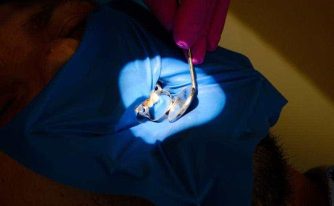 eroziunea dentara Dr Teo