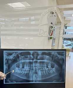 Clinica de medicină dentară Dr. TEO - Situații în care este recomandată extracția unui dinte 1 extractia dentara - Clinica de medicină dentară Dr. TEO - Situații în care este recomandată extracția unui dinte