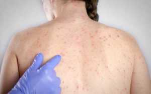 62408250 - O tânără de 24 de ani a murit din cauza rujeolei. Era nevaccinată