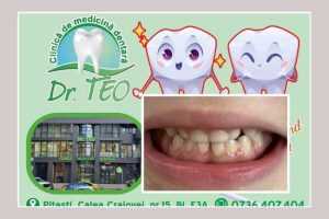 sigilarea la copii Dr. Teo