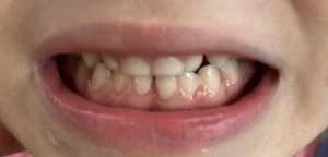 Clinica de medicină dentară DR TEO – SIGILAREA DINȚILOR 1 sigilarea la copii Dr. Teo