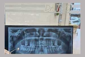 Clinica de medicină dentară DR TEO – Situații în care este recomandată extracția unui dinte 1 la dr Teo
