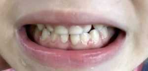 sigilarea la copii - Clinica de medicină dentară DR TEO – SIGILAREA DINȚILOR