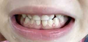 Clinica de medicină dentară DR TEO – SIGILAREA DINȚILOR 1 sigilarea la copii Dr. Teo