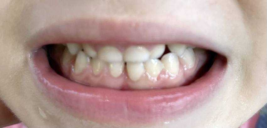 sigilarea la copii Dr. Teo sigilarea la copii Dr. Teo