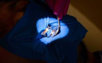 Dr Teo eroziunea dentara
