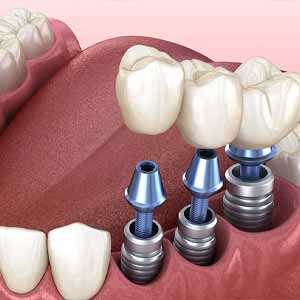 implant dentar Luy Esthetic 