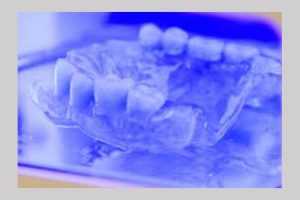 Clinica de medicină dentară DR TEO – PROTEZELE DENTARE CU CAPSE PE IMPLANTURI 1 dr Teo