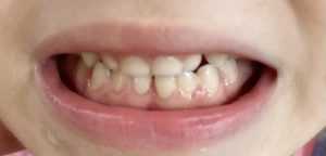 sigilarea la copii dr Teo