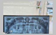 extractia dentara dr Teo
