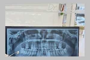 extractia dentara dr Teo