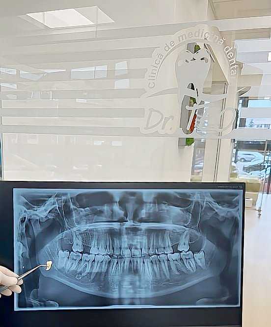 extractia dentara dr Teo