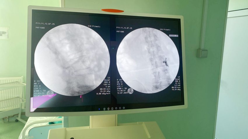 Nou! Infiltrații periradiculare ghidate radiologic efectuate la Spitalul Județean Pitești 2 SJU infiltratii