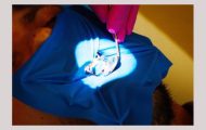 Dr Teo eroziunea dentara Dr Teo eroziunea dentara