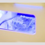 Clinica Dr. TEO - Protezele dentare cu capse pe implanturi 11 dr Teo Protezele dentare cu capse pe implanturi