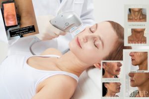 1 ULTRAFORMER3 deschidere 1 - Revoluția frumuseții începe la Zinart Clinique! Ultraformer III, tehnologia premium care întinerește pielea din interior!