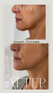 ultraformer iii 1 - Revoluția frumuseții începe la Zinart Clinique! Ultraformer III, tehnologia premium care întinerește pielea din interior!