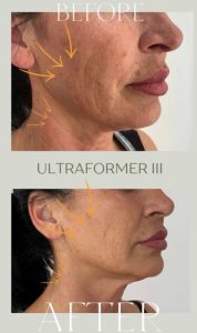 ultraformer iii - Revoluția frumuseții începe la Zinart Clinique! Ultraformer III, tehnologia premium care întinerește pielea din interior!