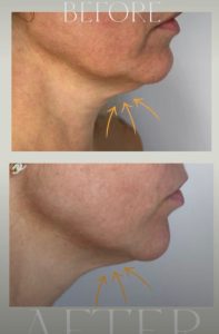 ultraformer iii 2 - Revoluția frumuseții începe la Zinart Clinique! Ultraformer III, tehnologia premium care întinerește pielea din interior!