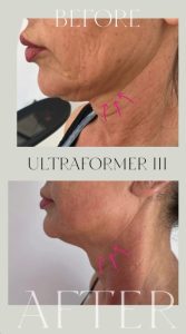 ultraformer iii 3 - Revoluția frumuseții începe la Zinart Clinique! Ultraformer III, tehnologia premium care întinerește pielea din interior!