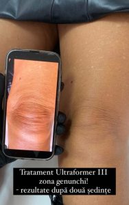 ultraformer iii 4 - Revoluția frumuseții începe la Zinart Clinique! Ultraformer III, tehnologia premium care întinerește pielea din interior!