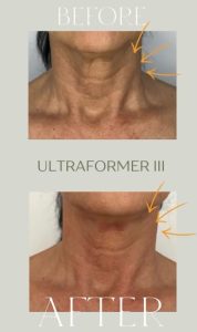 ultraformer iii 5 - Revoluția frumuseții începe la Zinart Clinique! Ultraformer III, tehnologia premium care întinerește pielea din interior!