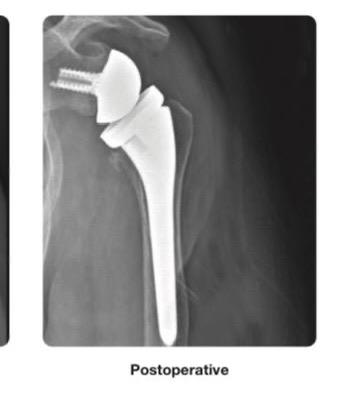 Intervenție de artroplastie totală de umăr cu proteză inversată
