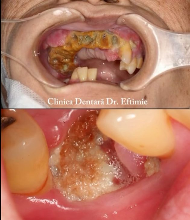 Sursă foto: screenshot FB Clinica Dentară Dr. Eftimie osteoporoză